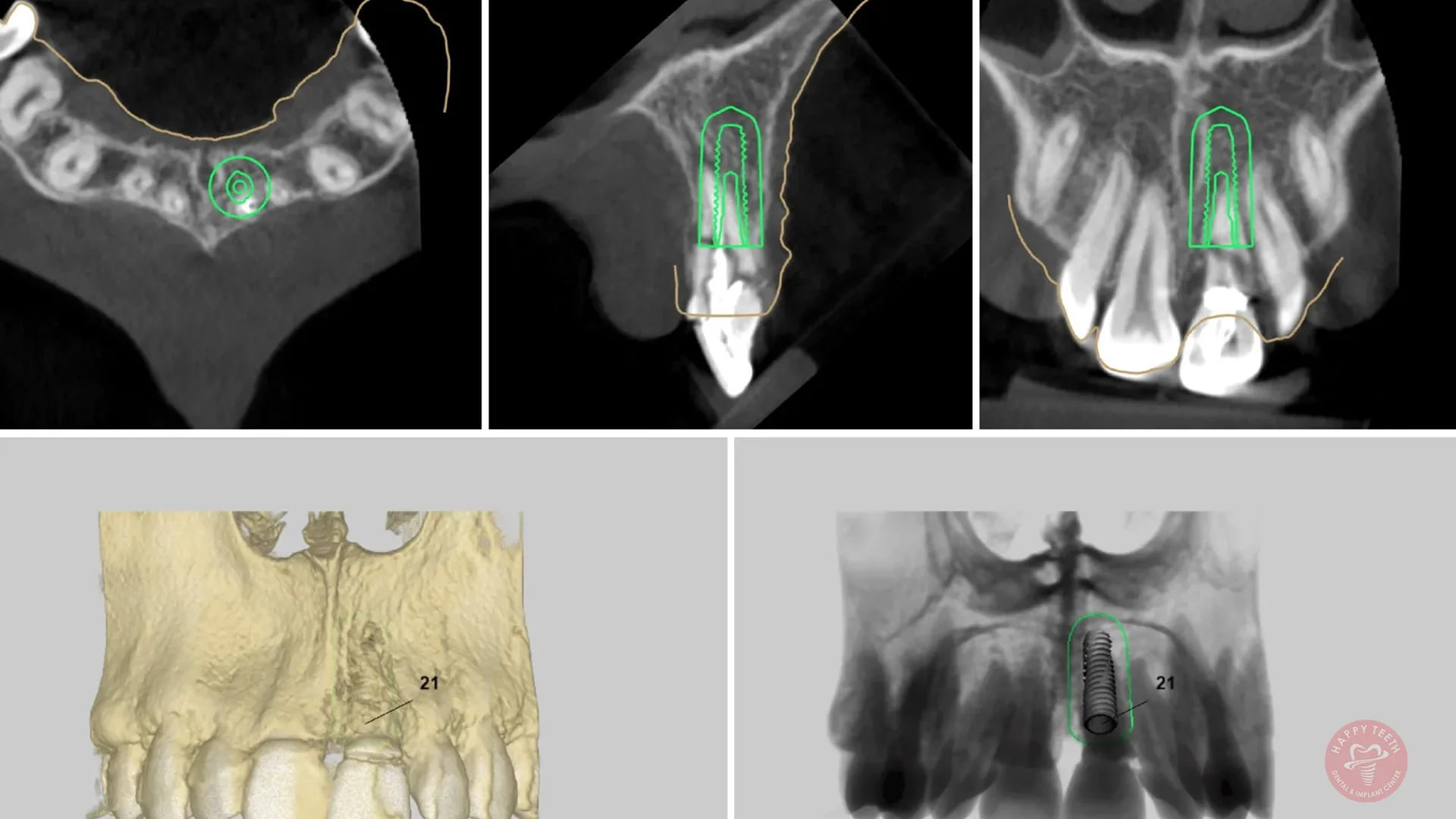 Digital Smile Designing at Happy Teeth Dental